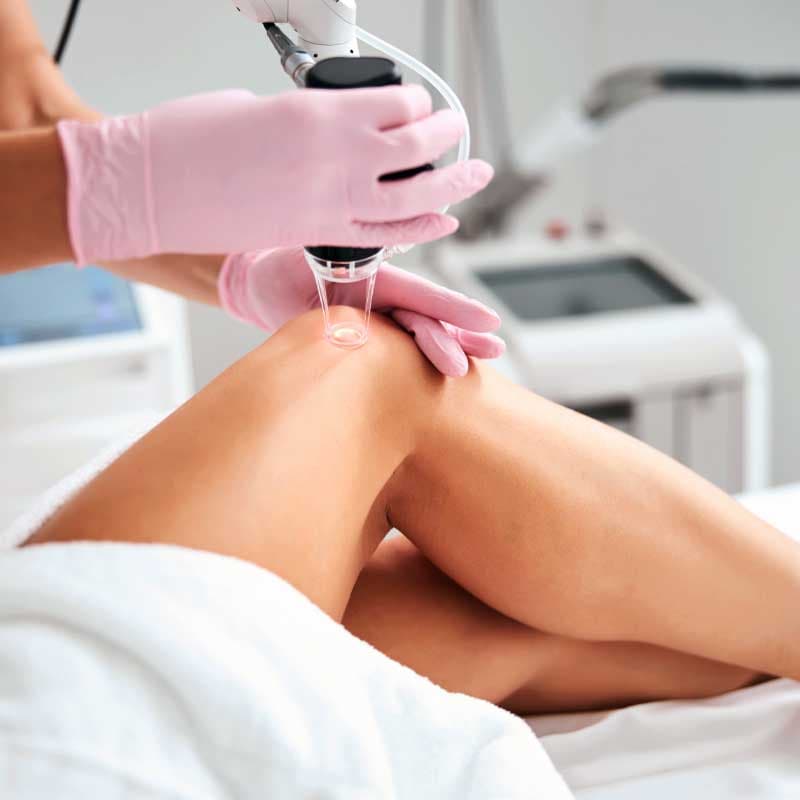 Laser-Haarentfernung